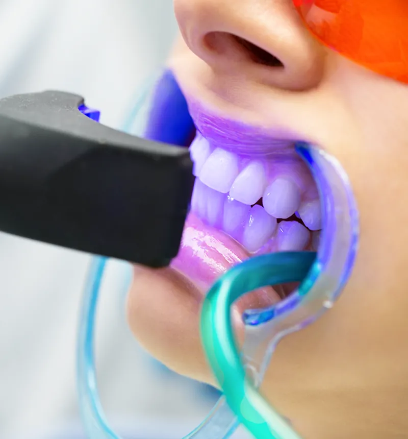 Ilustração do tratamento: Clareamento dental