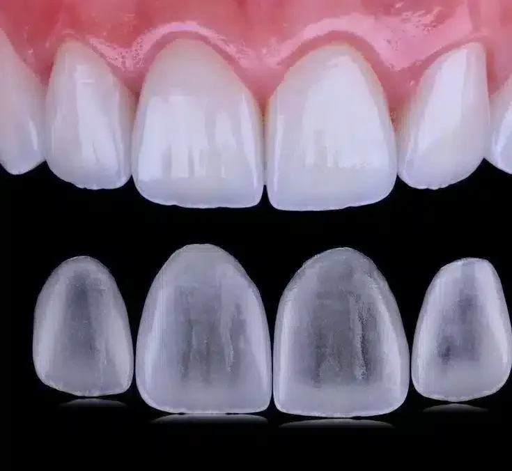 Ilustração do tratamento: Lente de contato dental